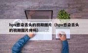 hpv感染舌头的初期图片（hpv感染舌头的初期图片疼吗）